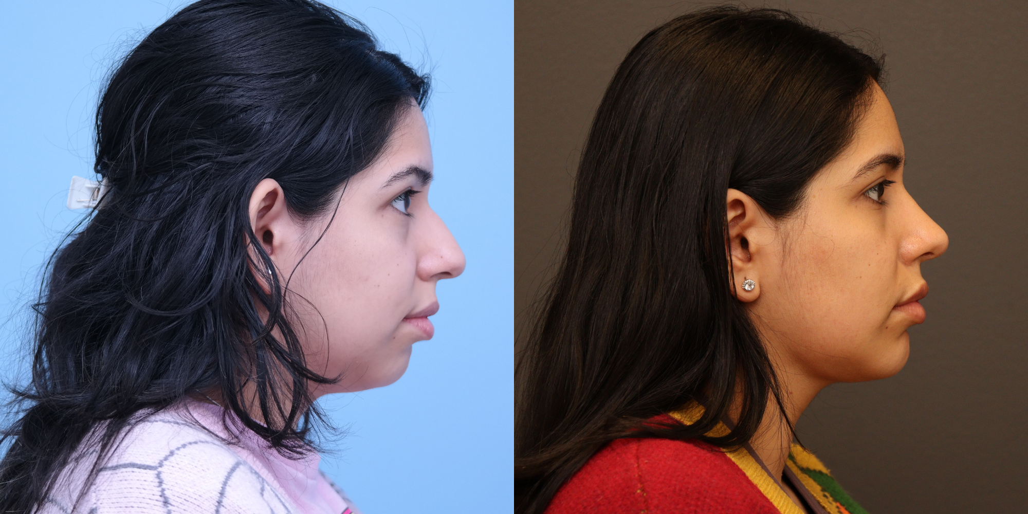 Rhinoplasty, Chin Implant