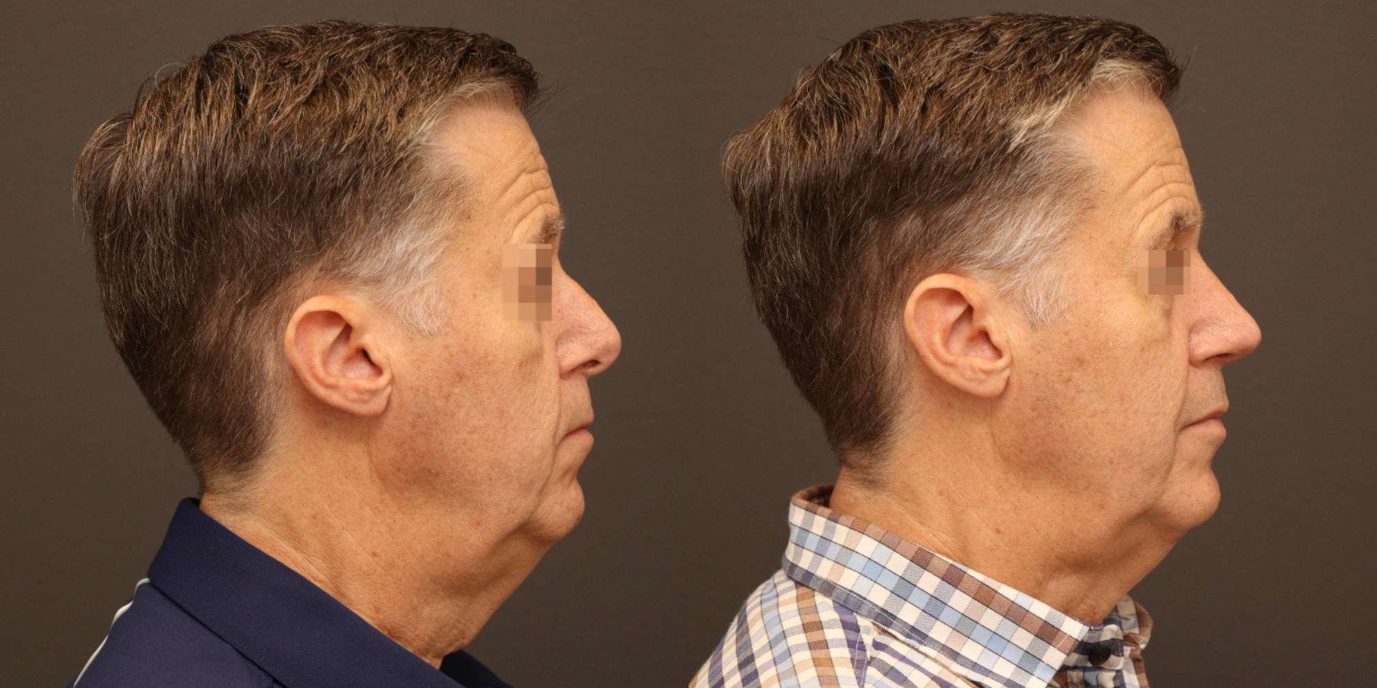 Rhinoplasty with Cadaveric Rib Grafting