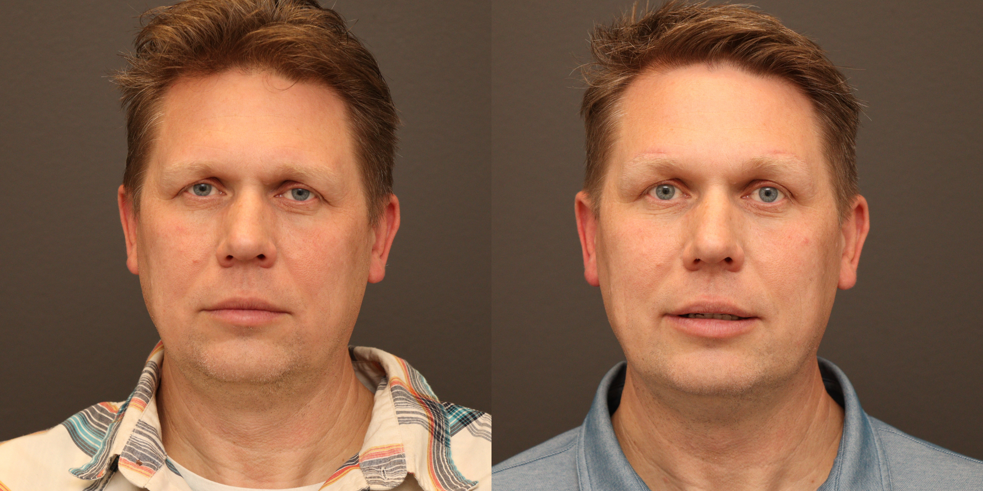 Ptosis Repair, Direct Brow Lift