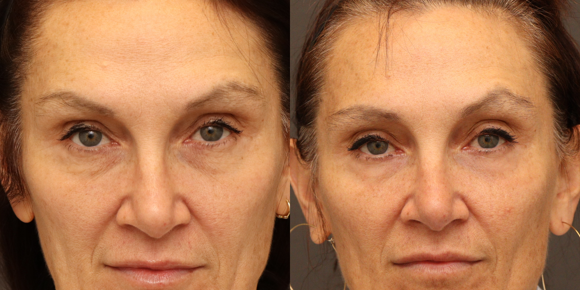 Periocular Laser Resurfacing