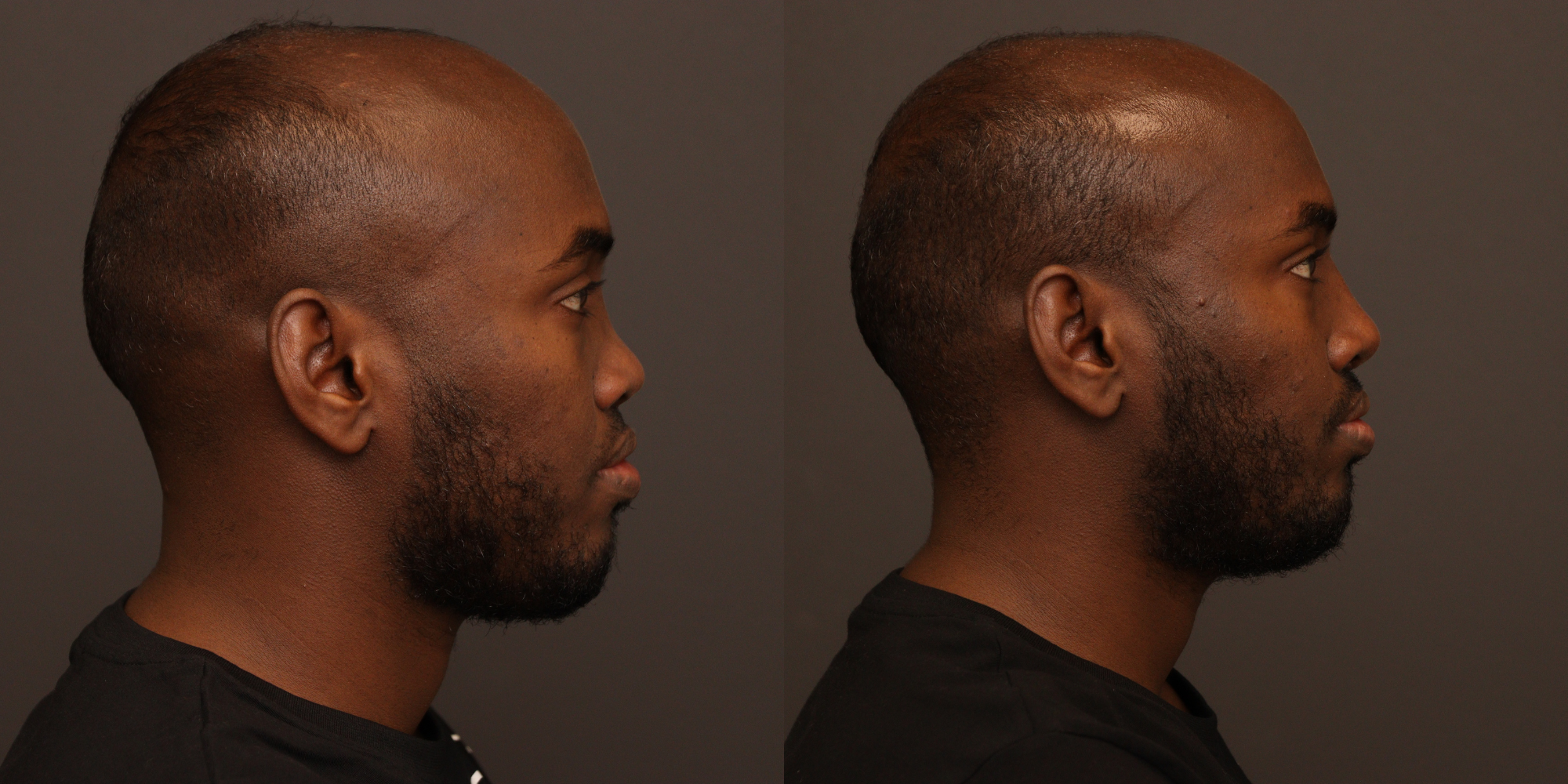Rhinoplasty with Cadaveric Rib Grafting