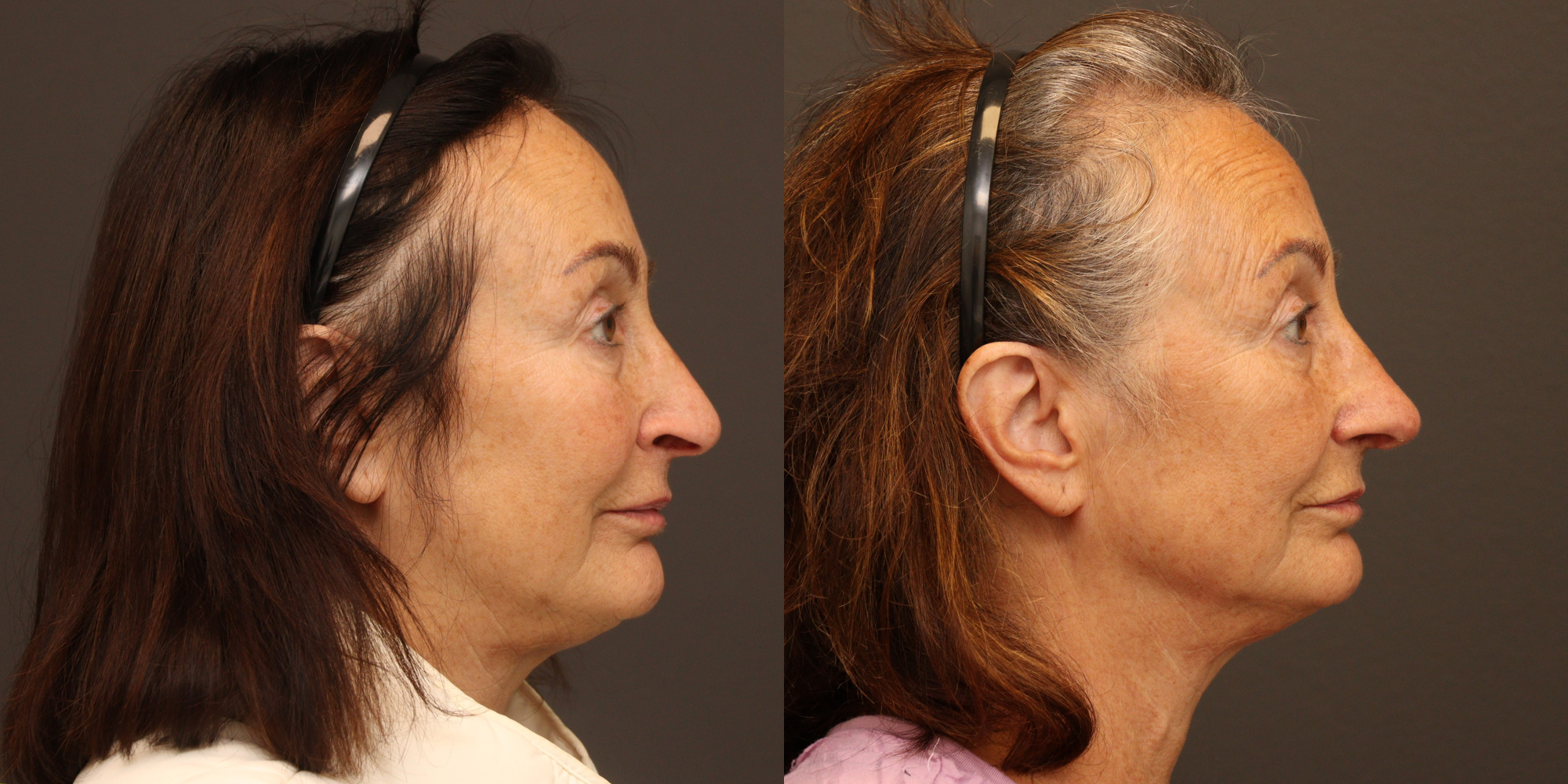 Revision Rhinoplasty with Autologous Rib Grafting
