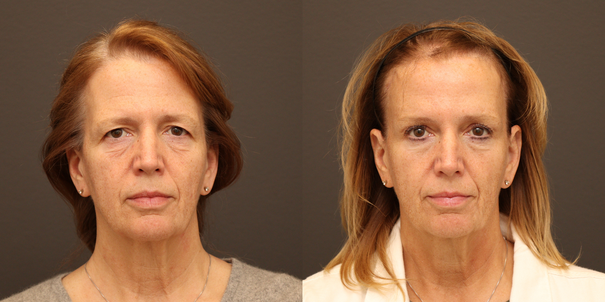 Upper Blepharoplasty, Endoscopic Brow Lift