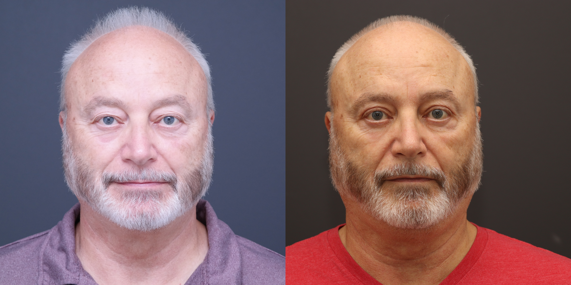 Upper Blepharoplasty