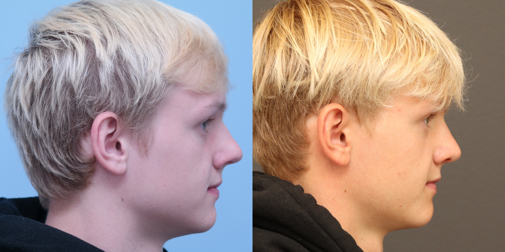 Rhinoplasty with Cadaveric Rib Grafting
