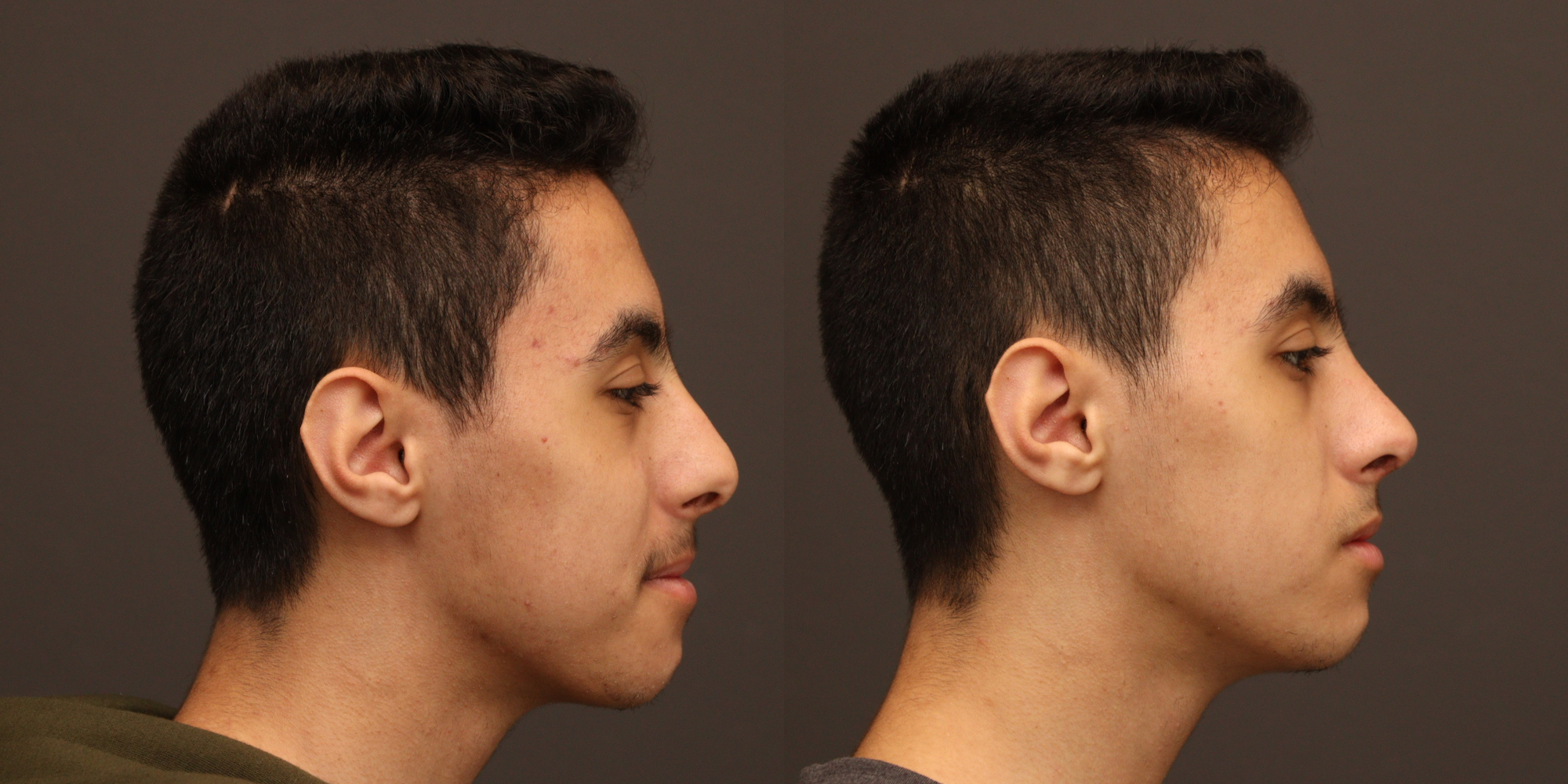 Rhinoplasty with Cadaveric Rib Grafting