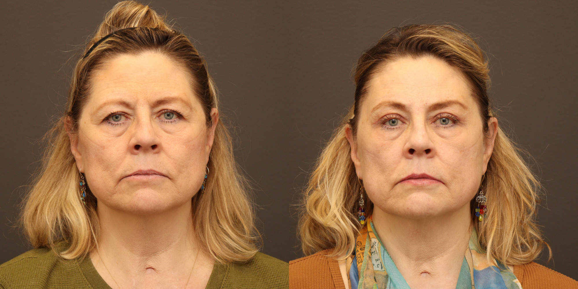Upper Blepharoplasty, Endoscopic Brow Lift