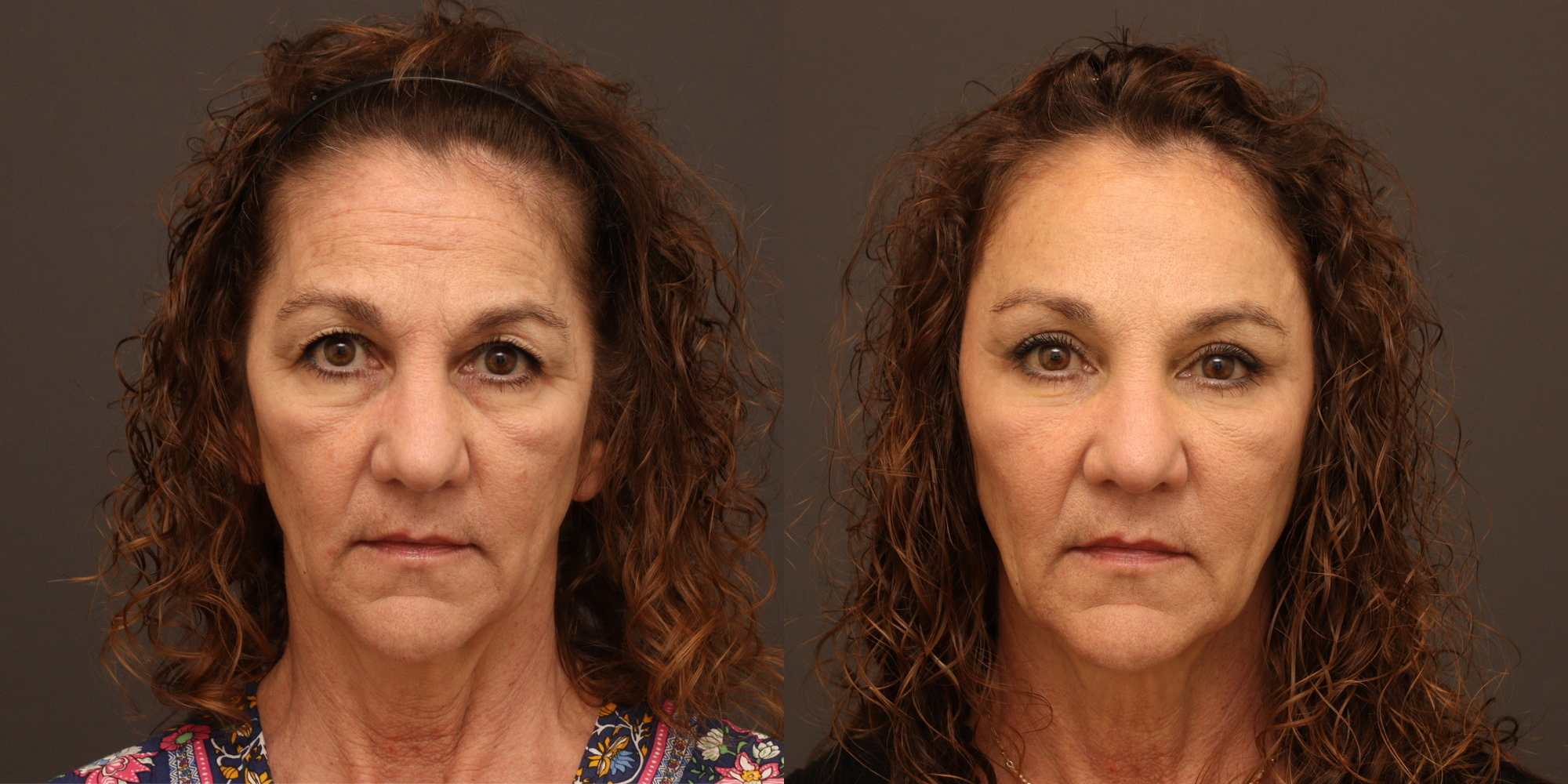 Upper & Lower Blepharoplasty, Endoscopic Brow Lift, Midface Fat Transfer, Lower Lid Laser