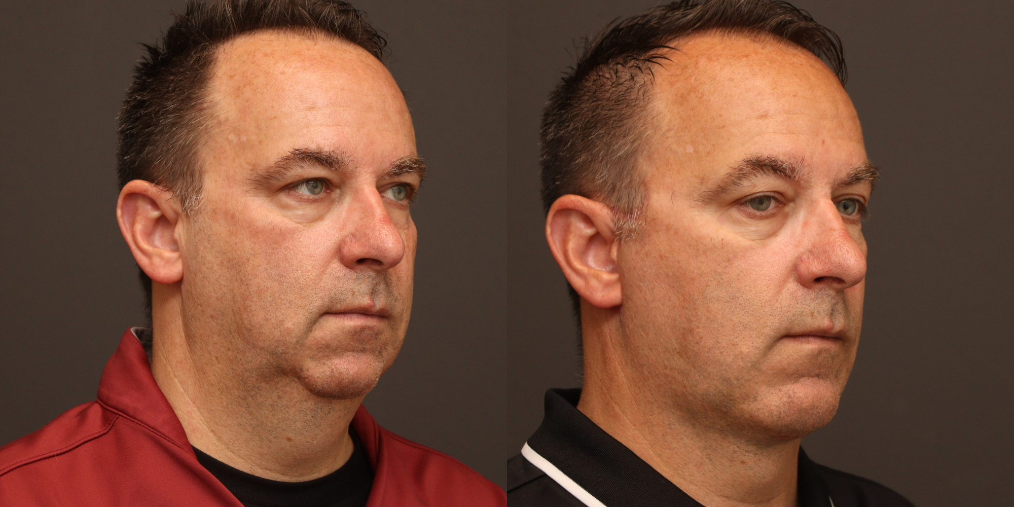 Deep Plane Face & Neck Lift, Chin Augmentation