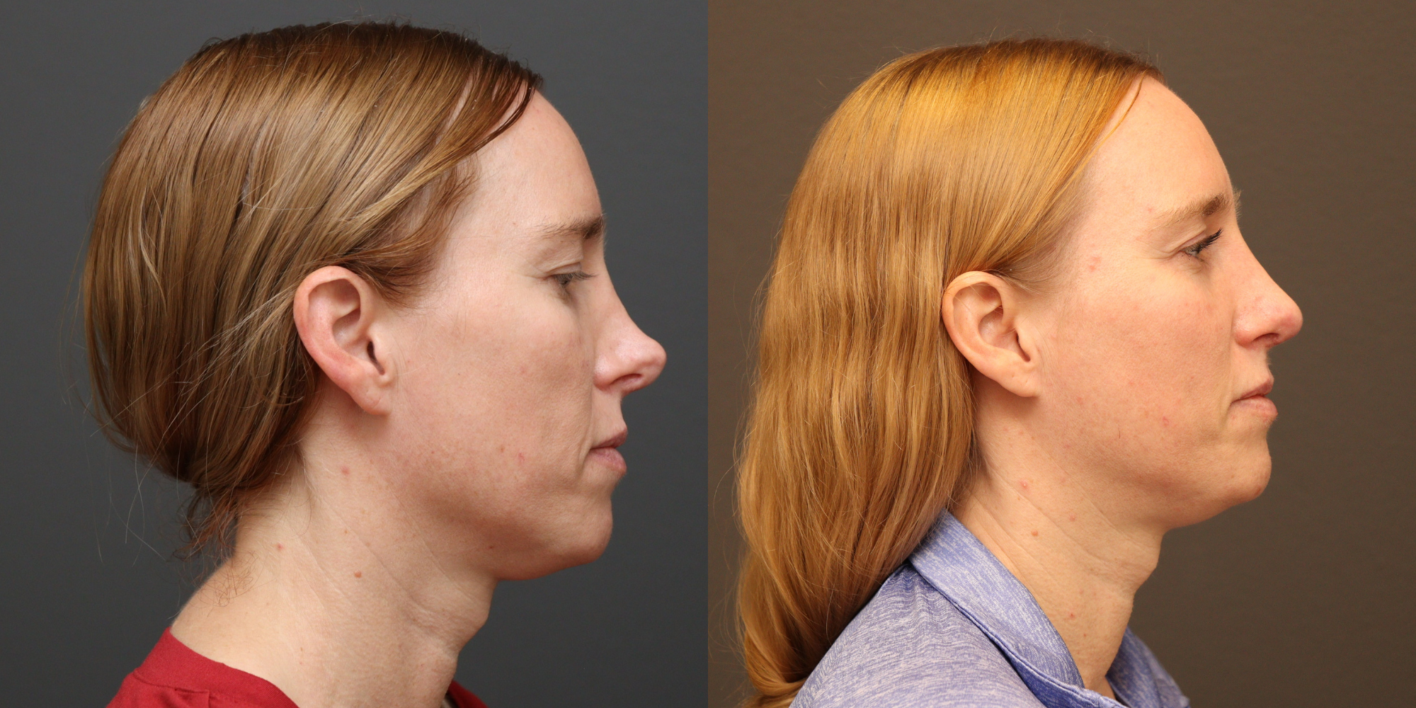 Revision Rhinoplasty with Autologous Rib Grafting
