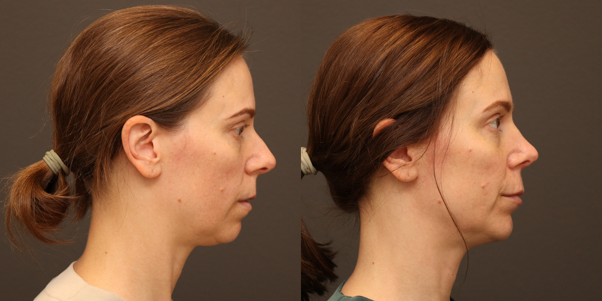 Rhinoplasty, Chin Augmentation