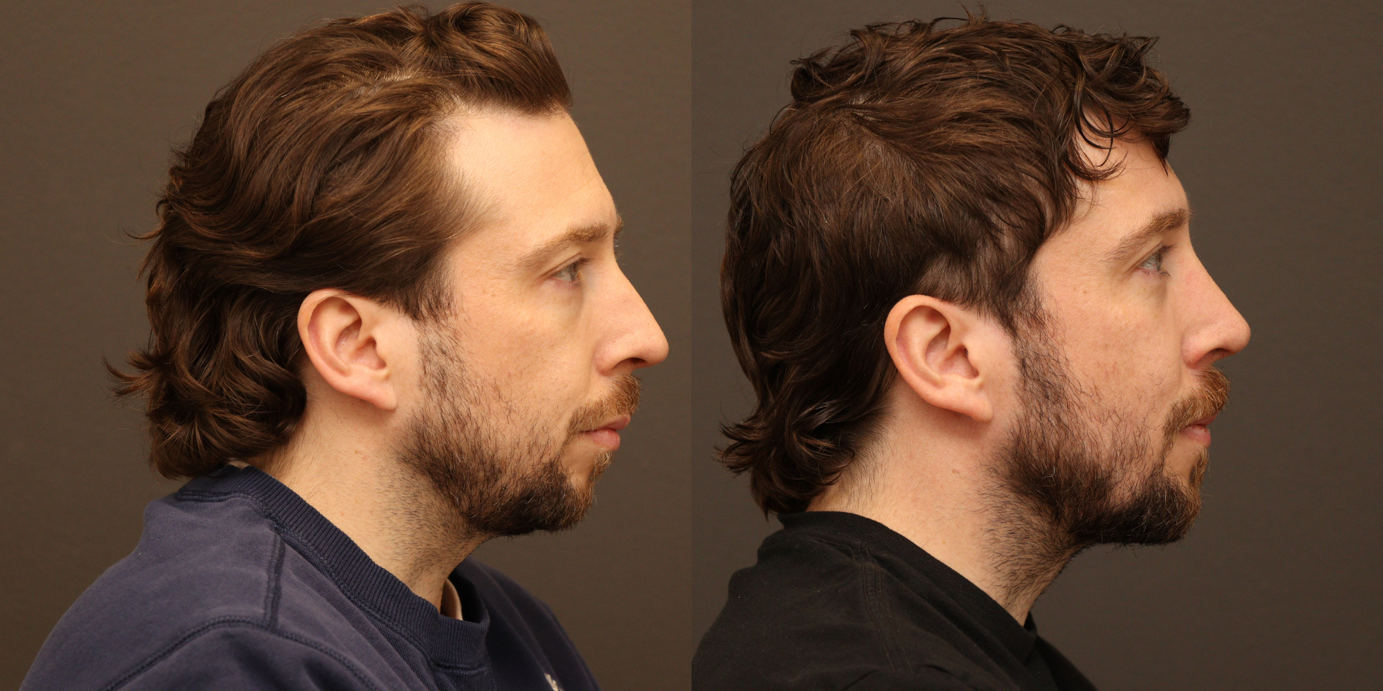 Rhinoplasty, Chin Augmentation