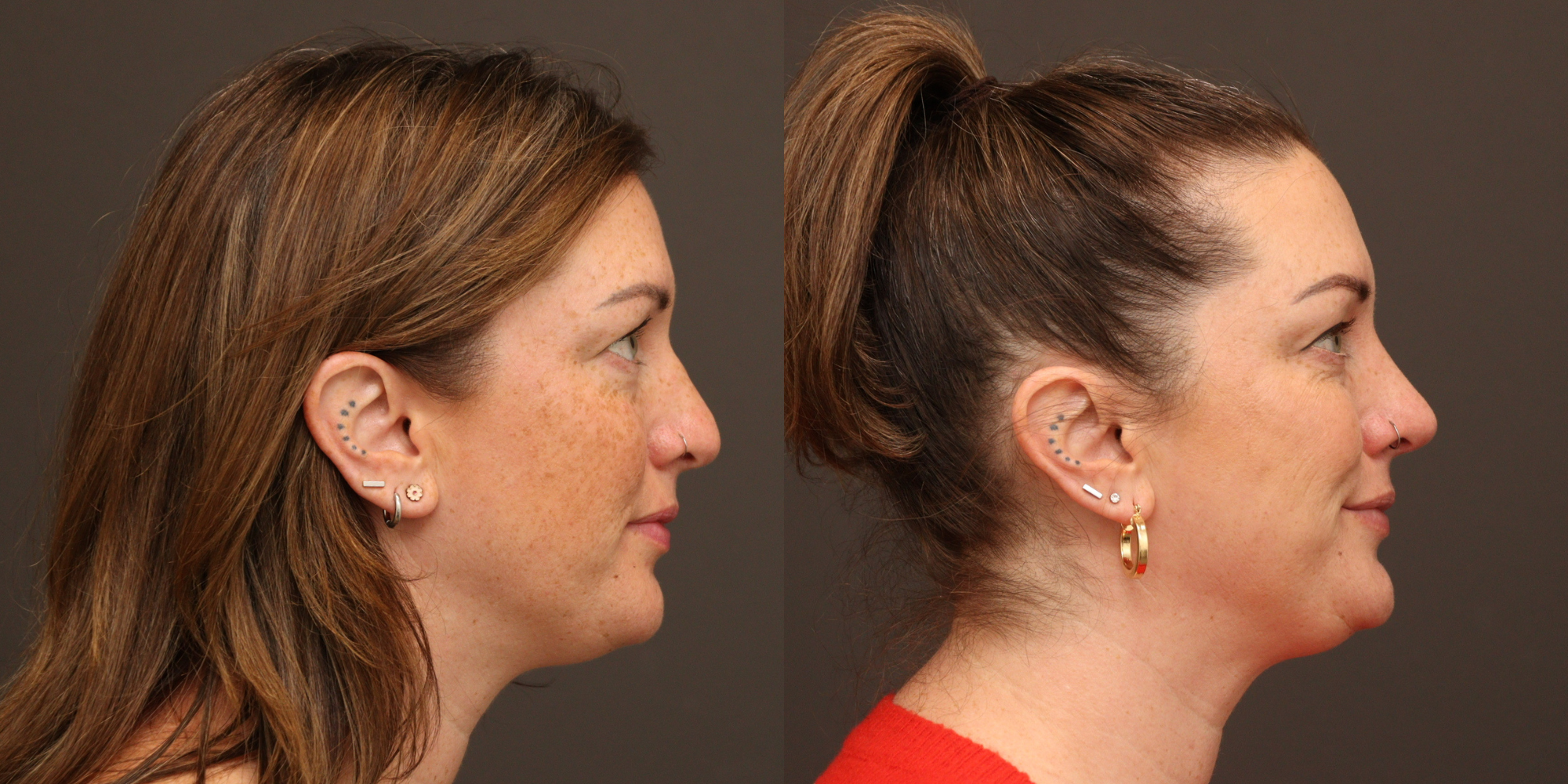 Revision Rhinoplasty with Cadaveric Rib Grafting