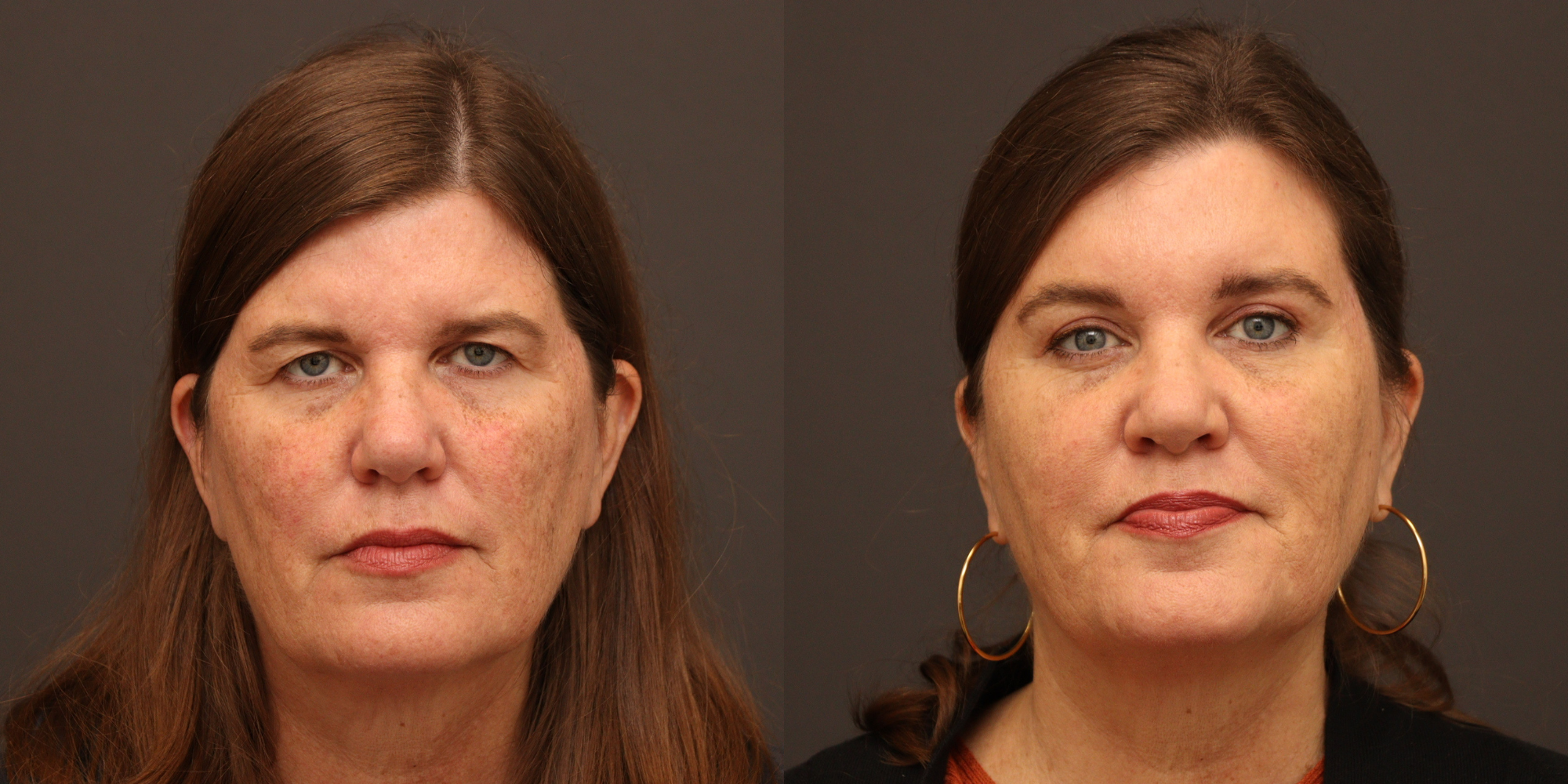 Upper Blepharoplasty, Endoscopic Brow Lift