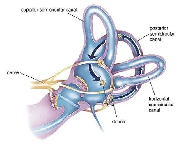 Illustration of the inner ear showing displaced calcium crystals that can cause BPPV and positional vertigo.