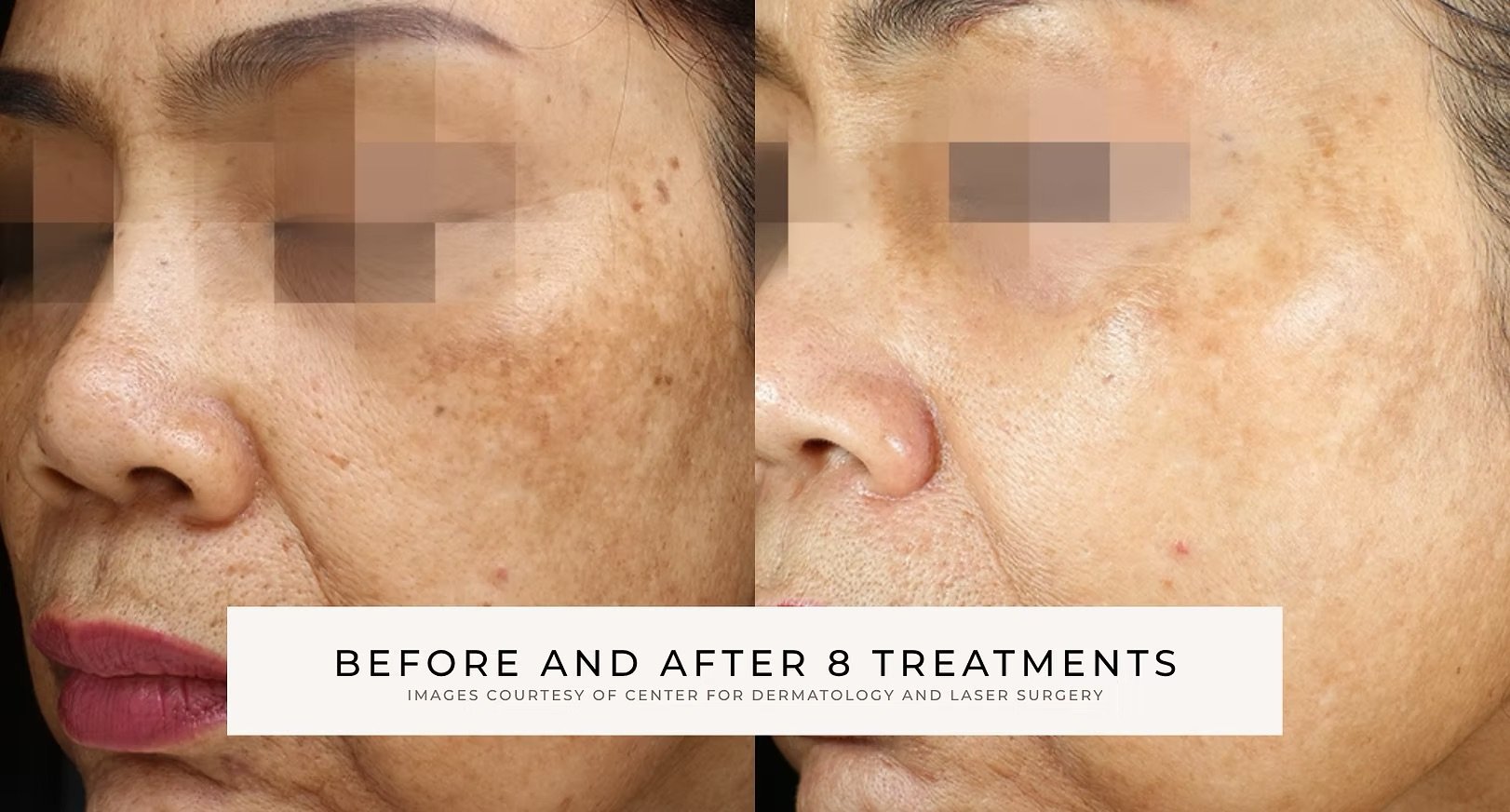 Before-and-after close-up of facial skin showing reduced brown pigmentation and dark spots after eight treatments