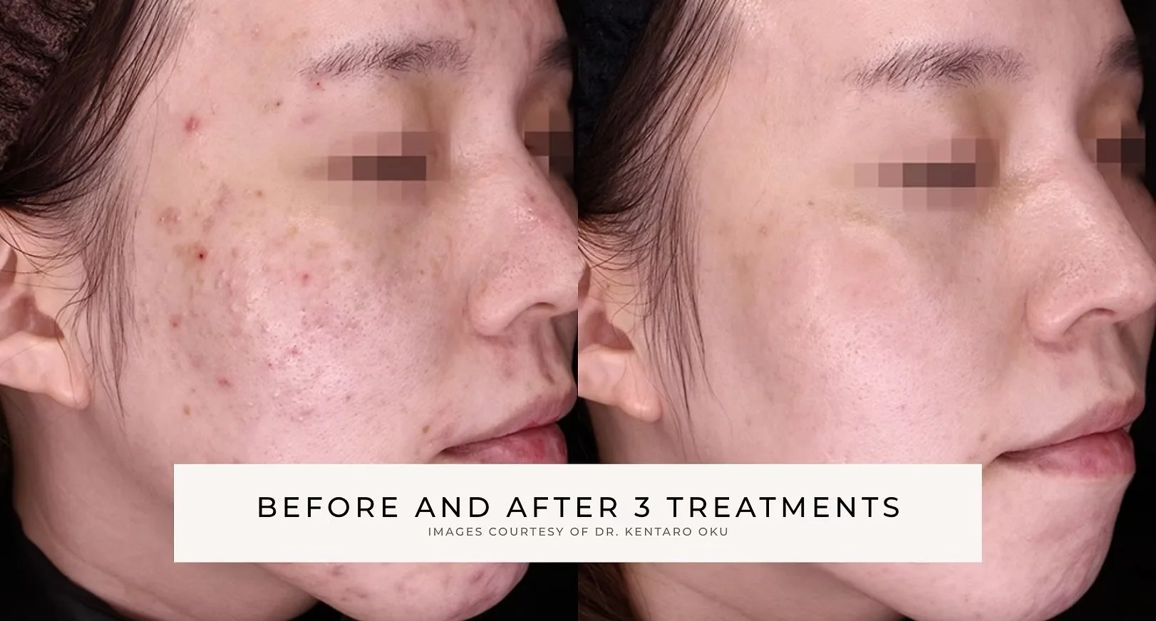 Before-and-after side-by-side facial photos showing improved acne, redness, and skin texture after three treatments.