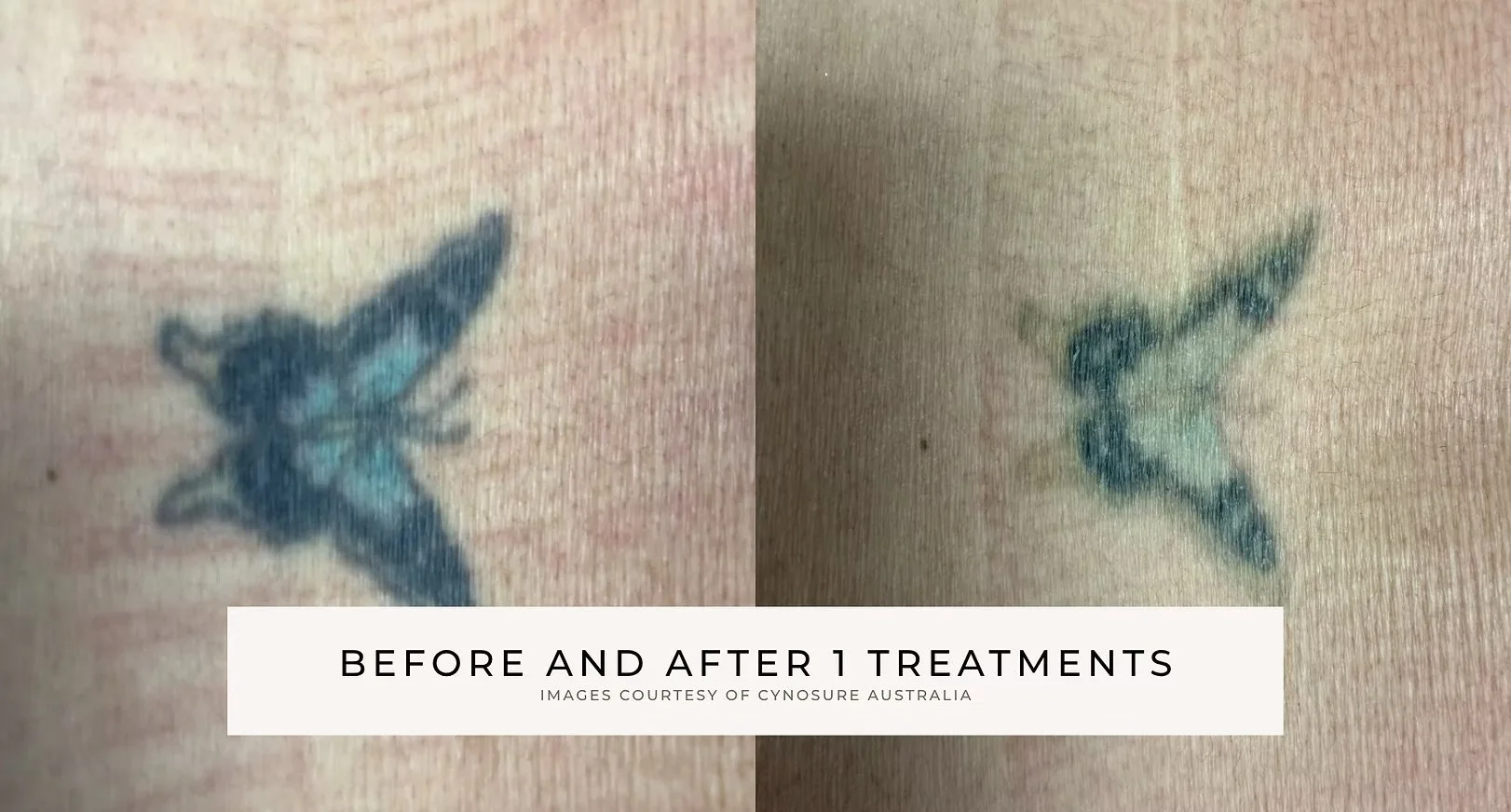 Before-and-after comparison of a dark blue-green tattoo on skin after one treatment