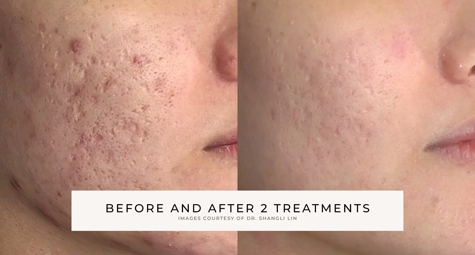 Before-and-after close-up of facial acne scars and uneven skin texture after two treatments
