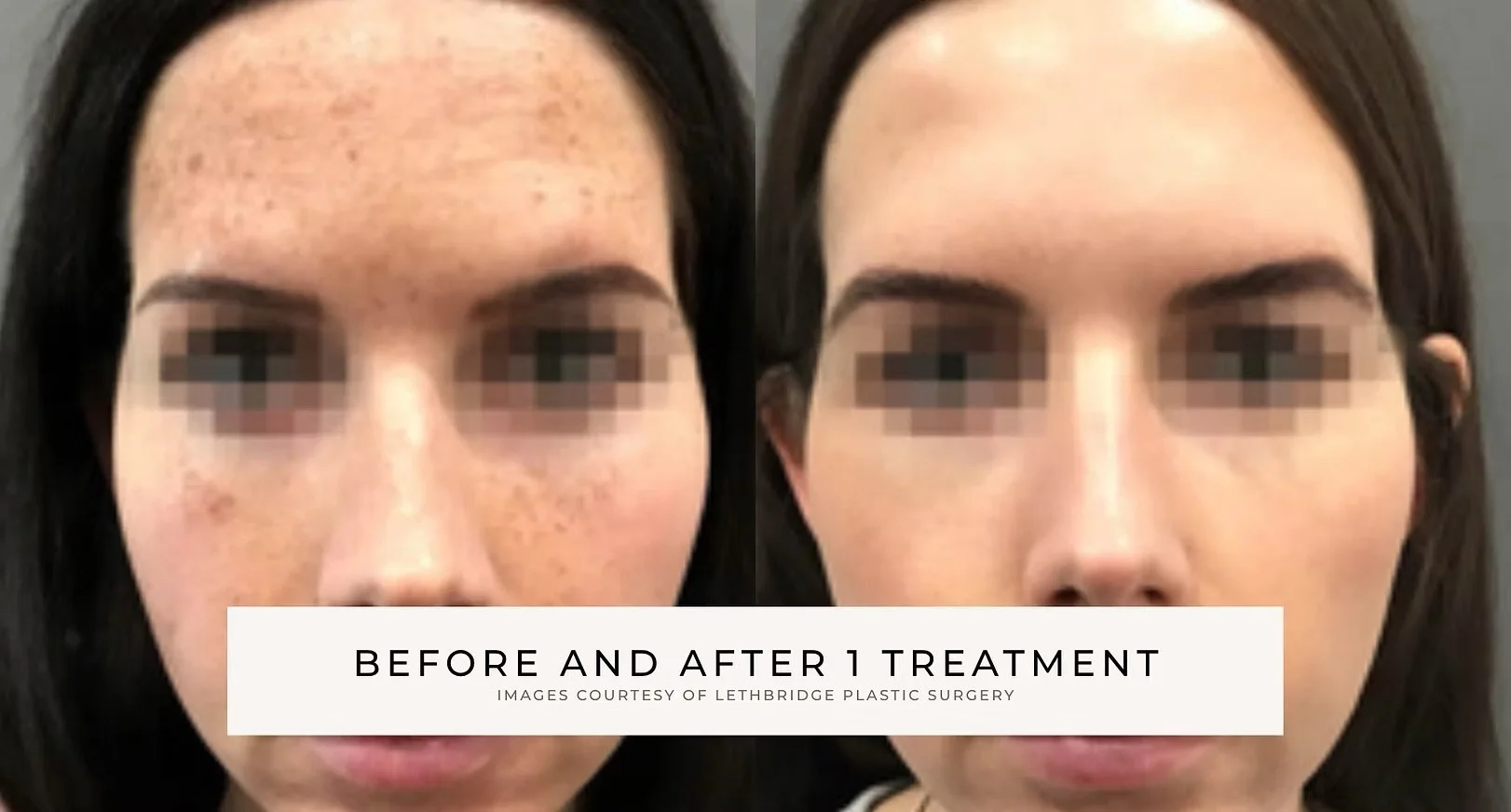 Side-by-side before-and-after facial photos showing improved skin texture and reduced blemishes after one treatment.