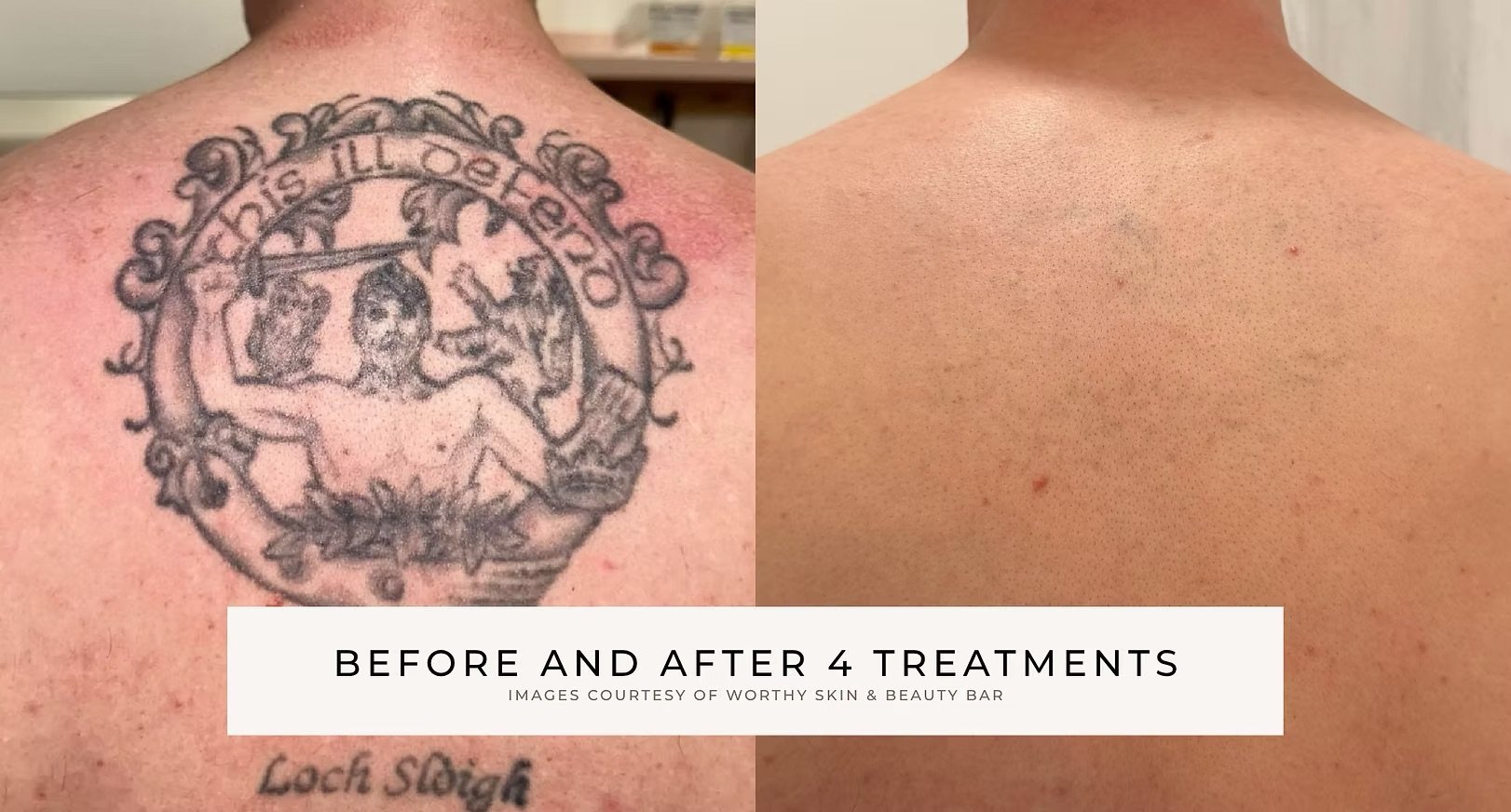 Before-and-after photo showing a large back tattoo significantly faded after four treatments, with text crediting Worthy Skin & Beauty Bar.