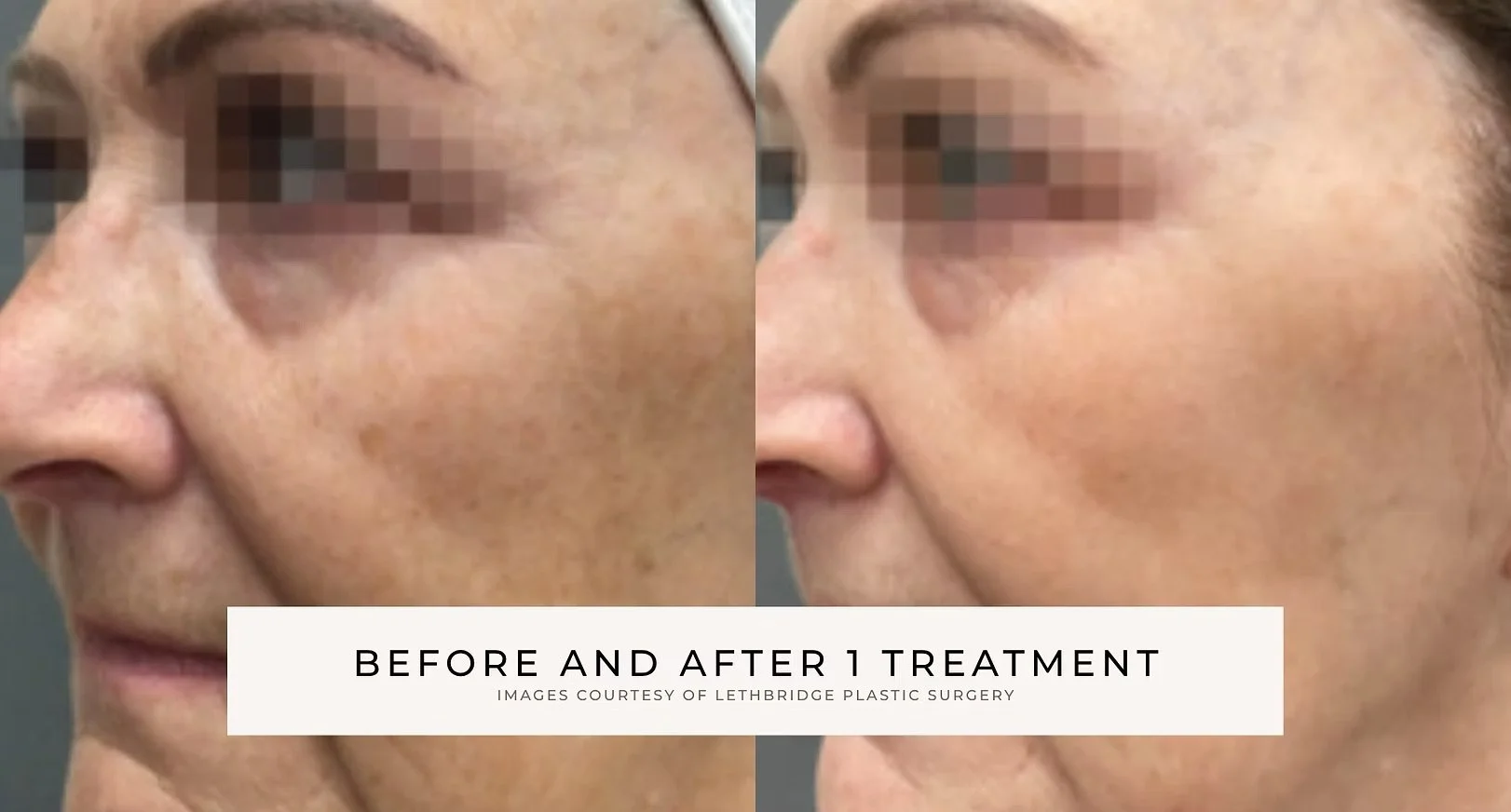 Before After 2