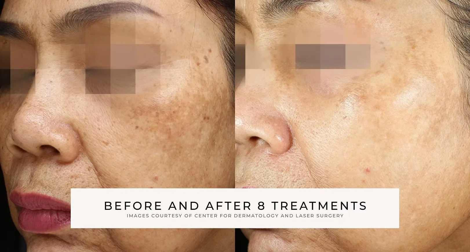 Before After 3