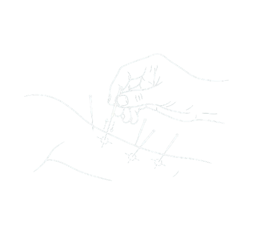 Medical illustration showing a hand performing acupuncture on an arm