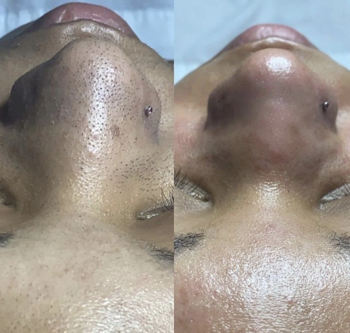 Close-up of a person's nose before and after skin treatment, showing the reduction of blackheads and pore size.