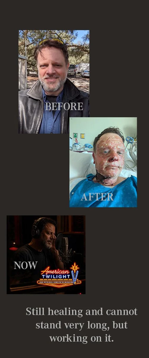 Sequence of images showing a man's recovery process: old photo labeled 'BEFORE' with the man smiling outdoors, a hospital photo labeled 'AFTER' showing the man with severe burns, and a current recording of the man singing into a microphone labeled 'NOW'. The caption reads: 'Still healing and cannot stand very long, but working on it.'