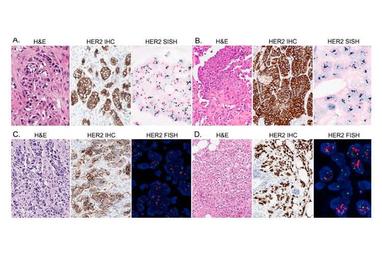 Diapositivas de microscopía de tejidos con diferentes tinciones y marcadores inmunohistoquímicos para HER2, mostrando diferencias en la expresión de HER2 en diferentes muestras cancerígenas.