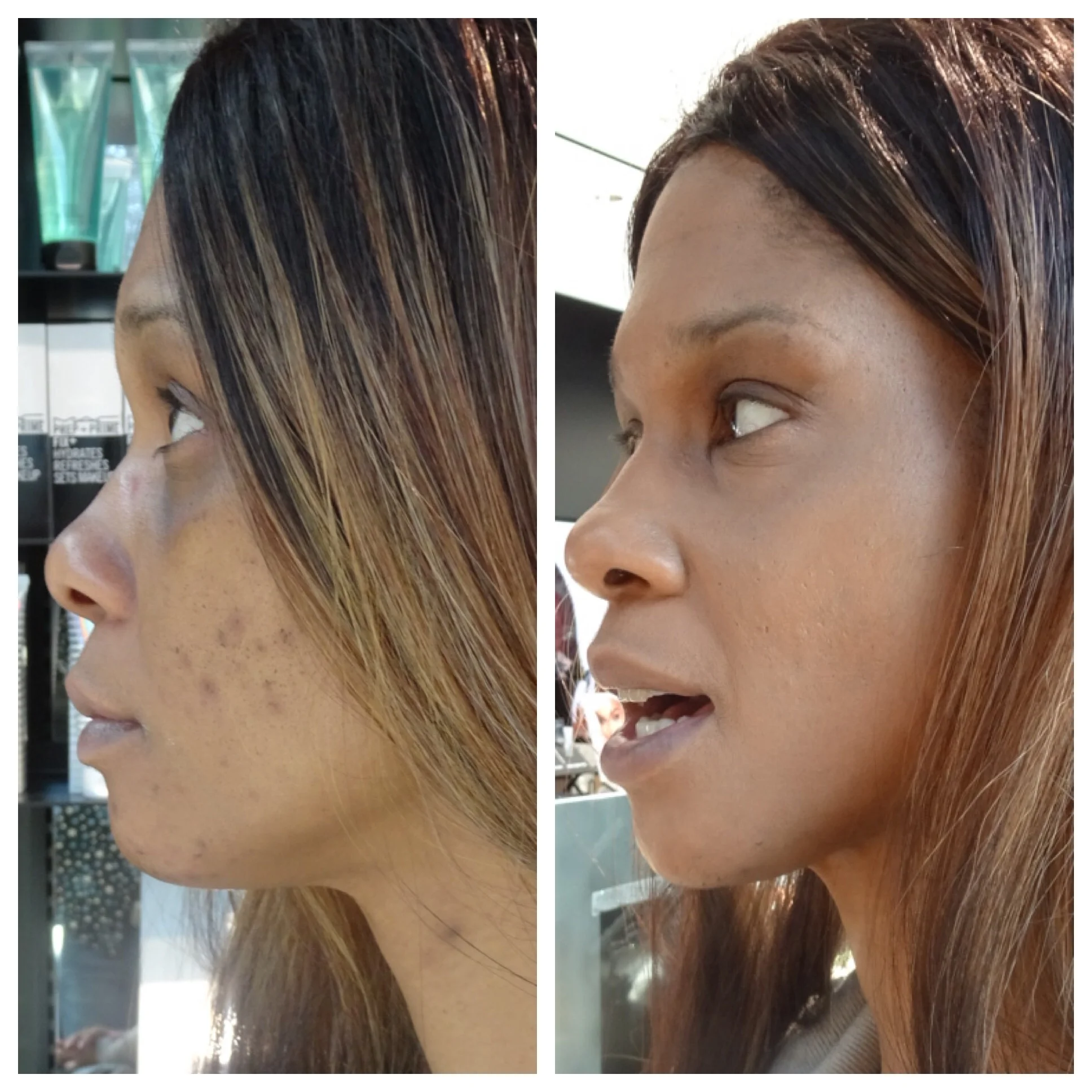 Covering blemishes on dark skin (Copy)