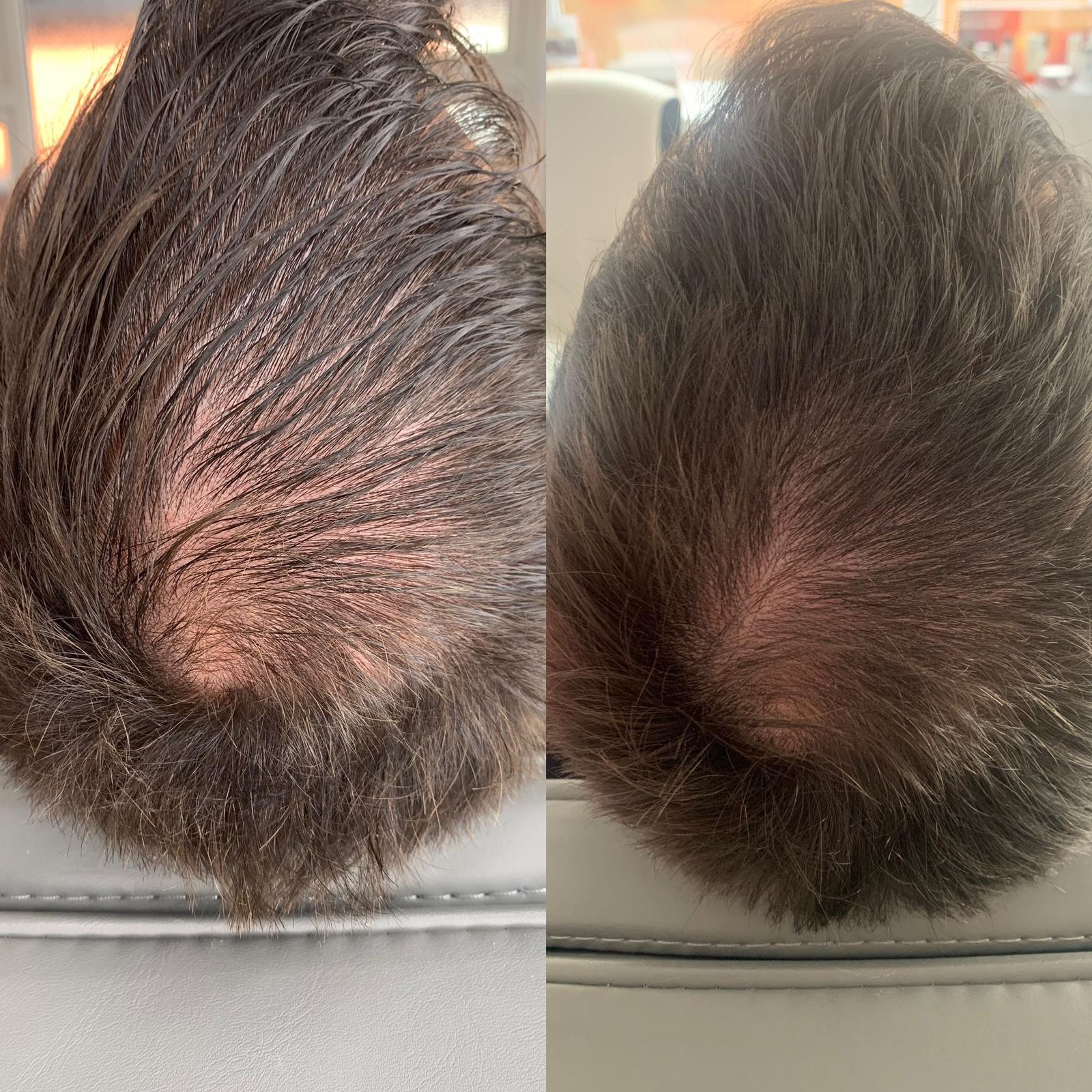 Everything You Need To Know About PRP Therapy For Hair Thinning And Loss: Efficacy, Safety, And More