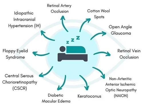 Discover the Surprising Link Between Sleep Apnea and Your Eye Health!