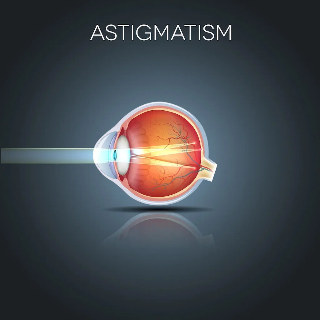 The Stigmas of Astigmatism