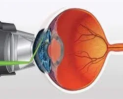 How Laser Technology is Revolutionizing Eyecare