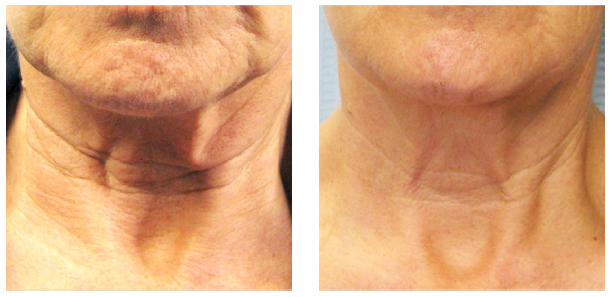 imgi_25_636d7f6fbe43b8611c3a9206_Tixel+Before+and+After+Neck.png