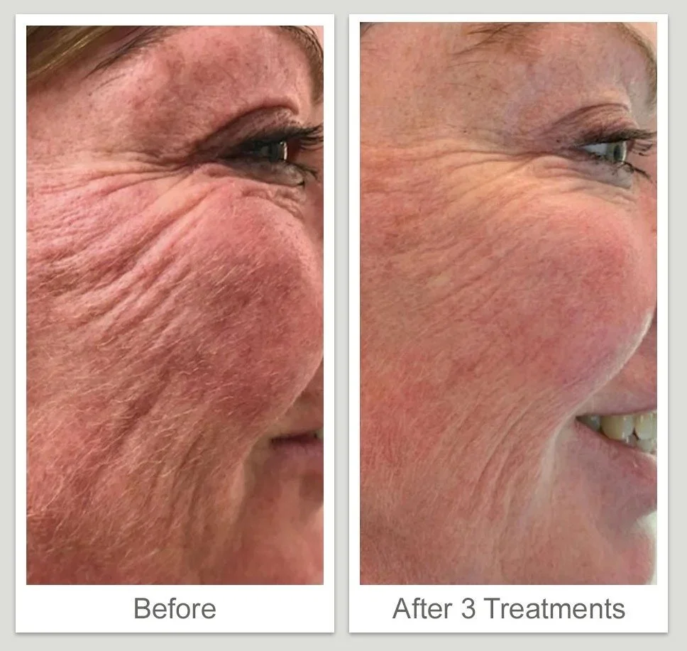 imgi_31_Tixel-Treatment-BA-Side-Face.jpg