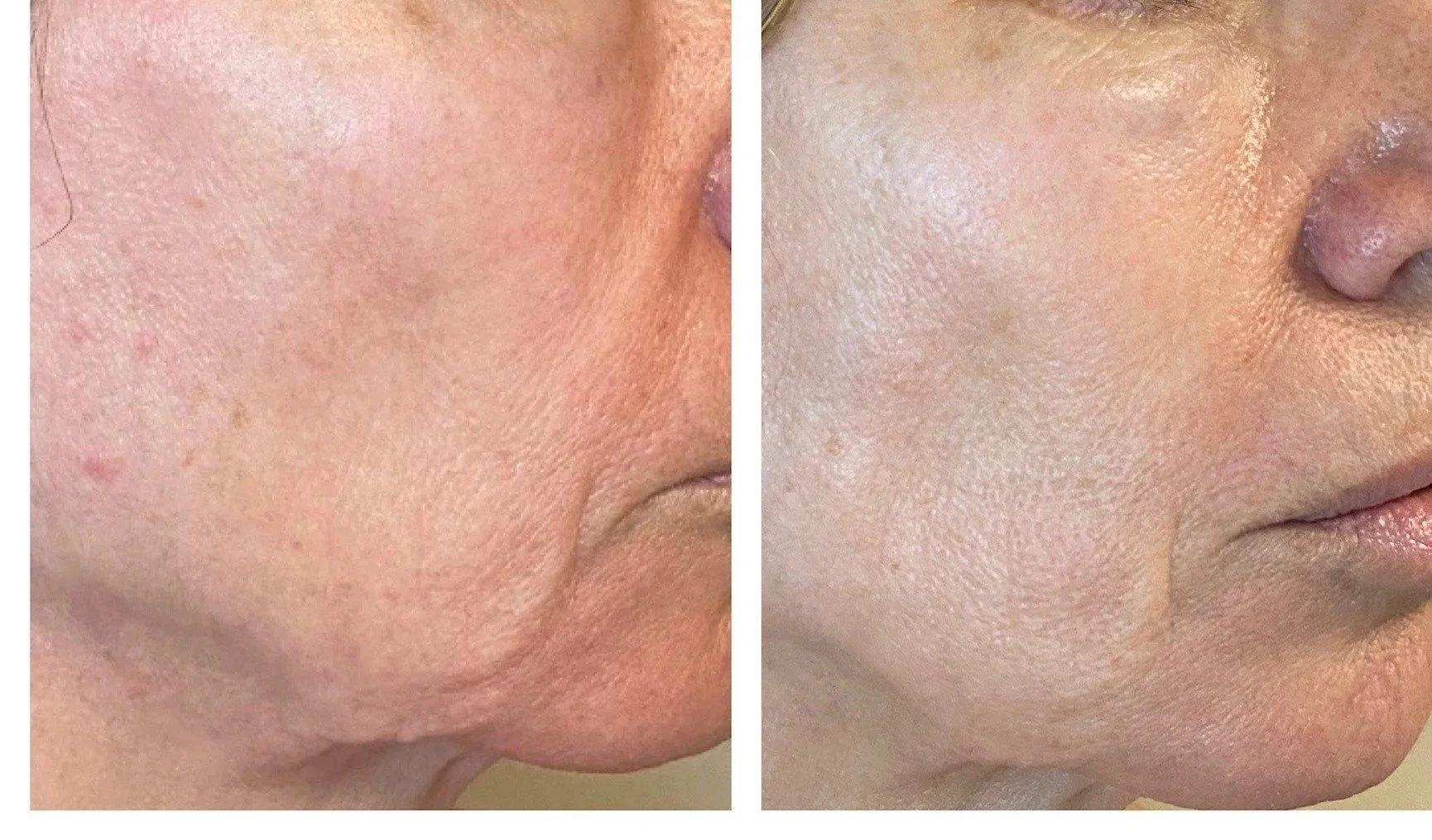 imgi_37_tixel-treatment-before-after-scottsdale-arizona.jpg