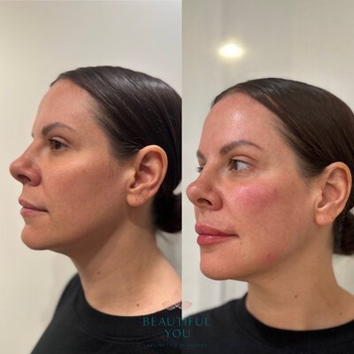 Medspa in Haverhill, MA 01835 l Before and After