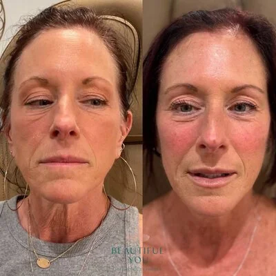 Medspa in Haverhill, MA 01835 l Before and After