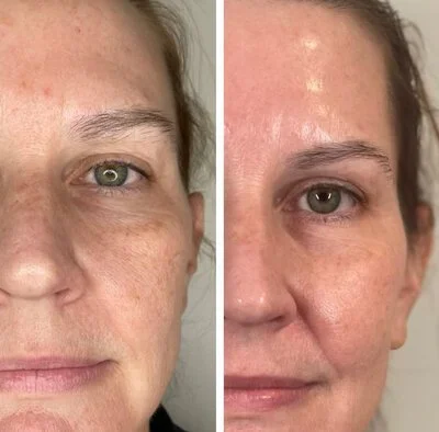 Medspa in Haverhill, MA 01835 l Before and After