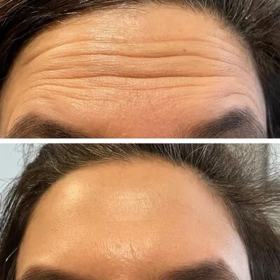 Medspa in Haverhill, MA 01835 l Before and After