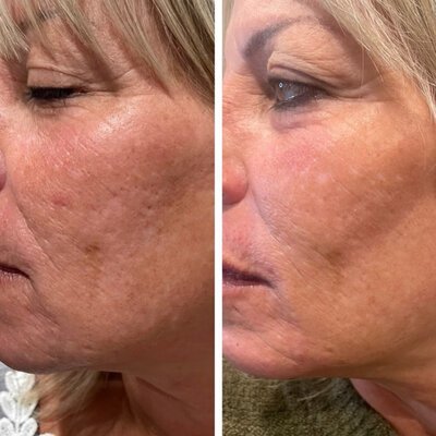 Medspa in Haverhill, MA 01835 l Before and After