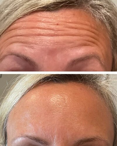 Medspa in Haverhill, MA 01835 l Before and After