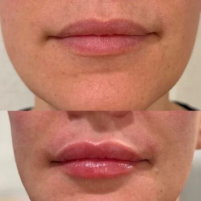 Medspa in Haverhill, MA 01835 l Before and After