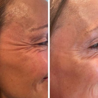 Medspa in Haverhill, MA 01835 l Before and After