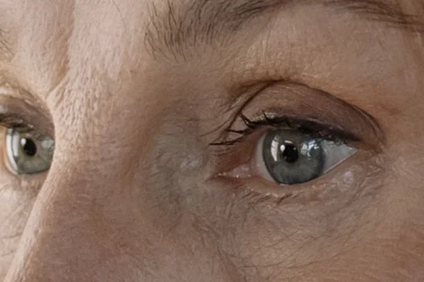 Under-Eye Bags and Dark Circles: What Can Lower Blepharoplasty Improve?