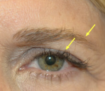 Heavy upper eyelids — blepharoplasty, brow lift, and/or ptosis repair