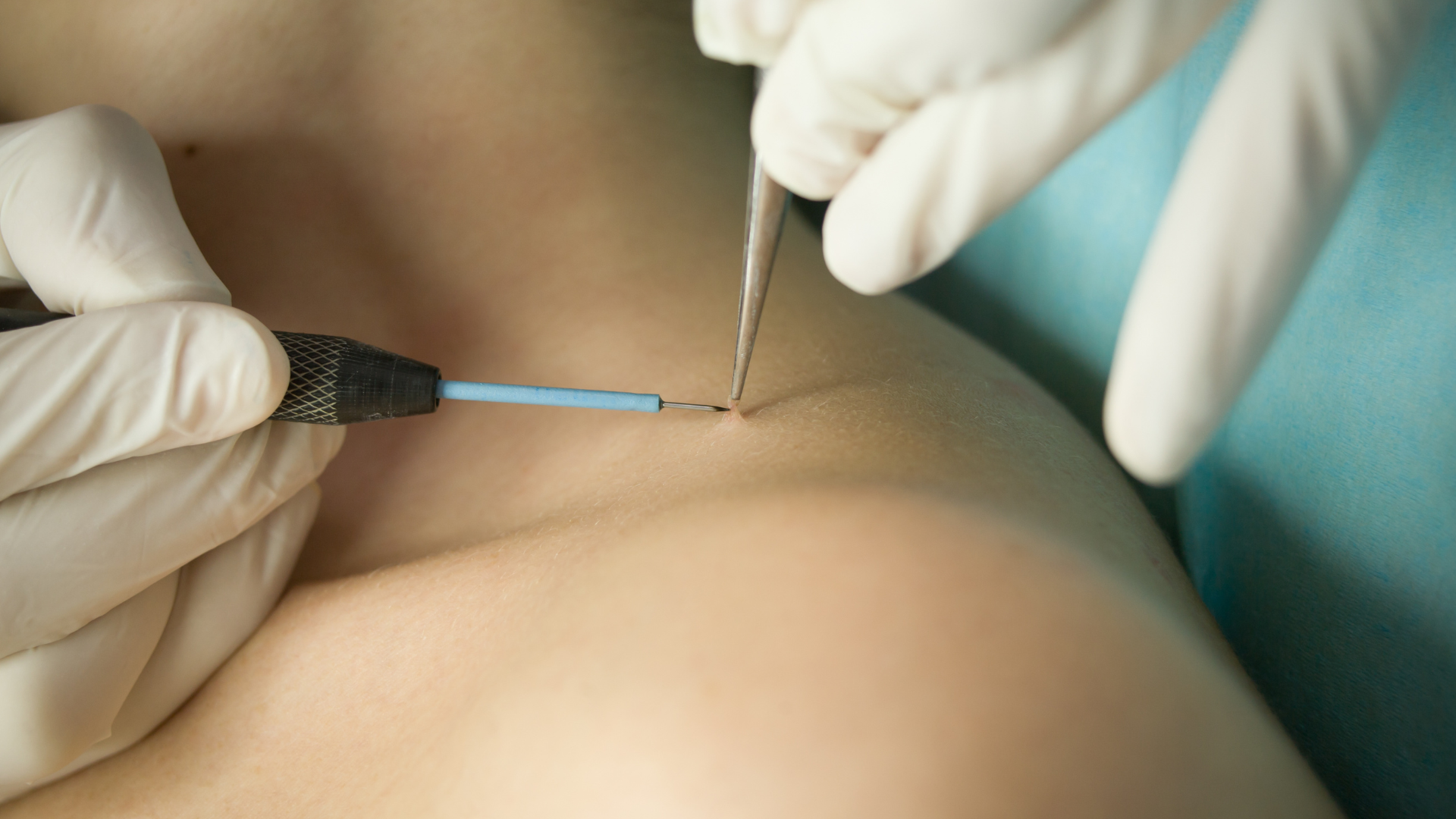 A medical procedure involving a needle and surgical tools on a patient's skin, with gloved hands holding the instruments.